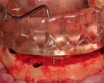 Bone reduction and surgical guide combo - DENTATE